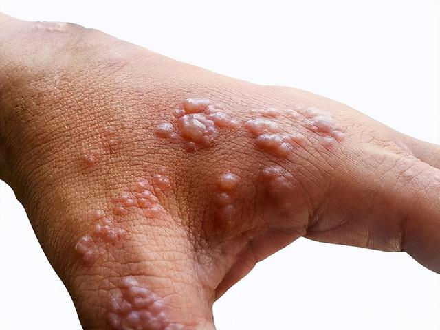手上起小水泡很痒怎么回事 湿疹（手上起小水泡很痒怎么回事会传染吗）