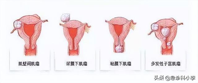 0岁子宫肌瘤是什么原因导致的（子宫肌瘤是什么原因导致的图片）"